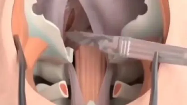 تصاویری از نحوه برداشتن تومور مغزی