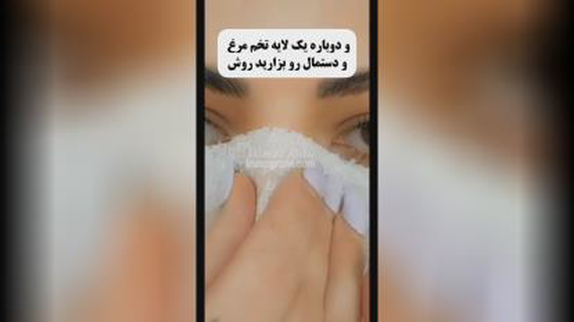 ••اگه جوش سرسیاه داری با این روش همشون رو از بین ببر••🪄