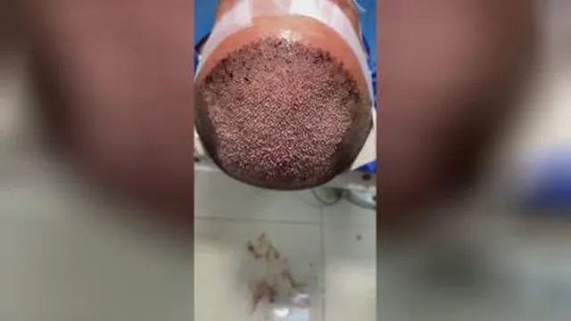 بهترین کاشت مو شیراز