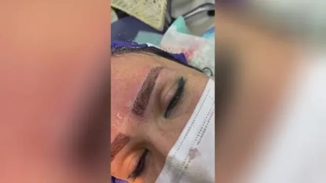 بهترین کاشت مو شیراز