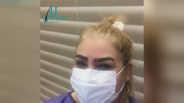 کاشت ابروی طبیعی در اصفهان