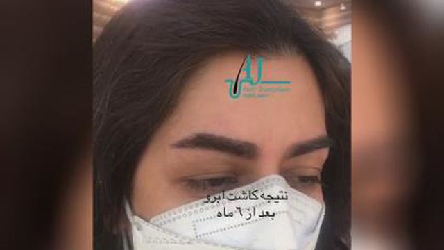 کاشت ابروی طبیعی در اصفهان