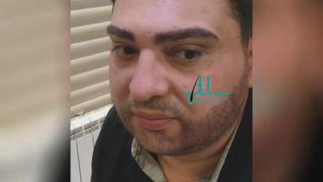 بهترین مرکز کاشت ابرو در اصفهان