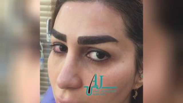 بهترین مرکز کاشت ابرو در اصفهان