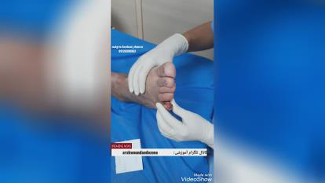 مراقبت از پای دیابتی