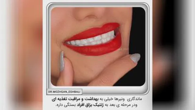 ونیر کامپوزیت
