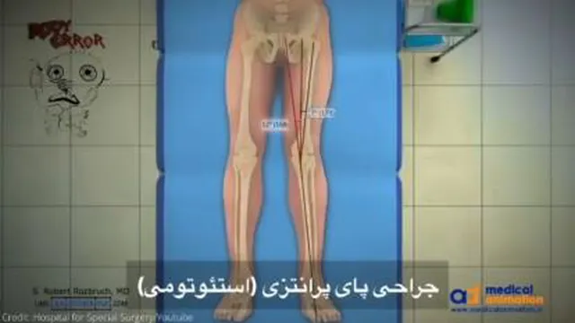 جراحی پای پرانتزی