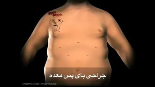 جراحی بای پس معده