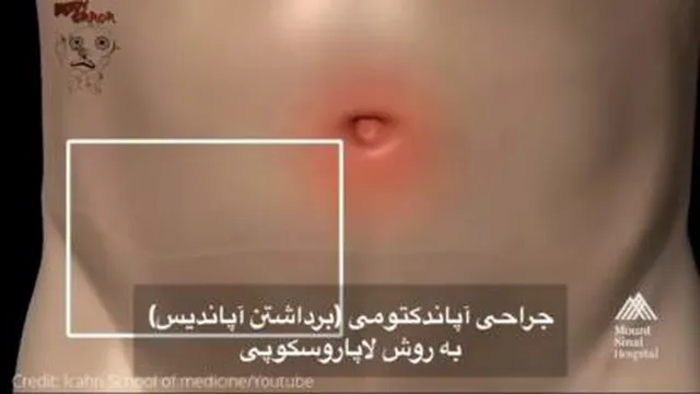 جراحی آپاندیس