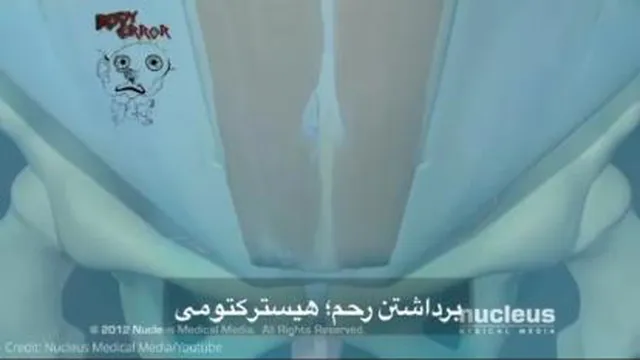 برداشتن رحم