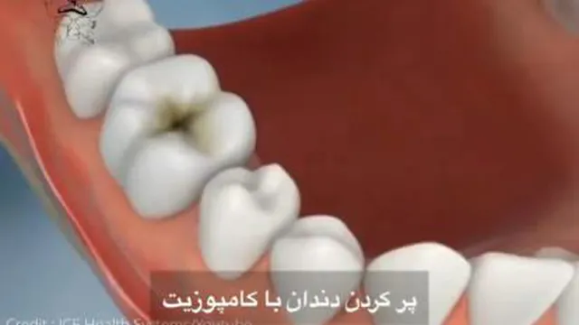 پر کردن دندان با کامپوزیت