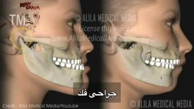 عمل جراحی فک