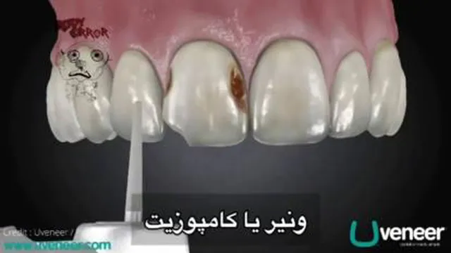 ونیر یا کامپوزیت دندان