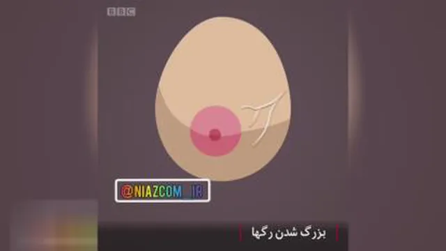 12 نشانه که به تشخیص هر چه زودتر سرطان سینه کمک میکنند ( ☝️)