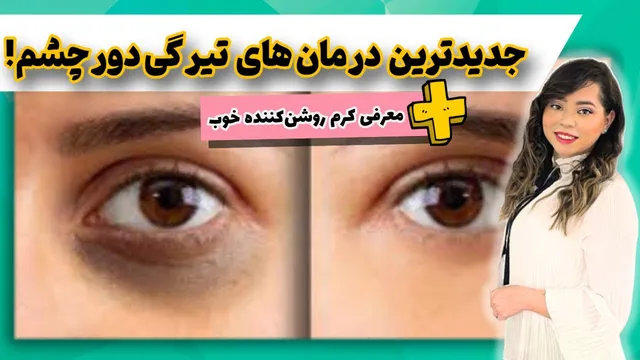 بهترین روش‌های درمان تیرگی دور چشم | نکات کلیدی انتخاب کرم ضد لک و روشن‌کننده دور چشم