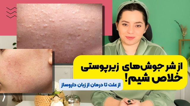 راهنمای کامل درمان جوش‌های زیرپوستی: چه کارهایی باید انجام دهید و چه کارهایی نباید