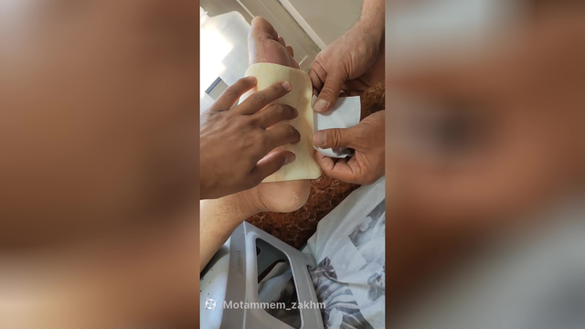 آموزش نحوه استفاده از فوم (متمم_زخم)