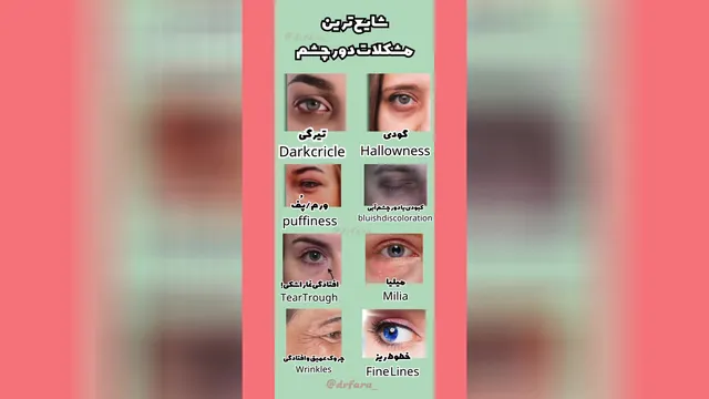 کدام چشم شماست؟ رایج‌ترین مشکلات دور چشم