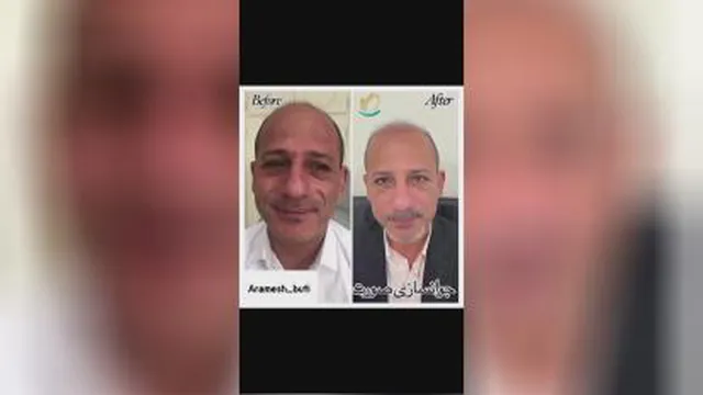 جوانسازی صورت در گوهردشت کرج