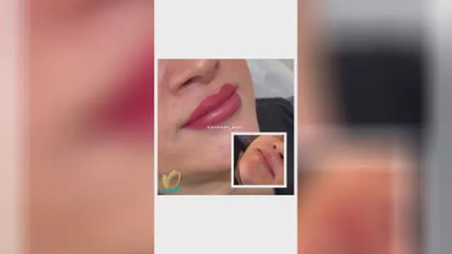 فیلر لب در گوهردشت کرج