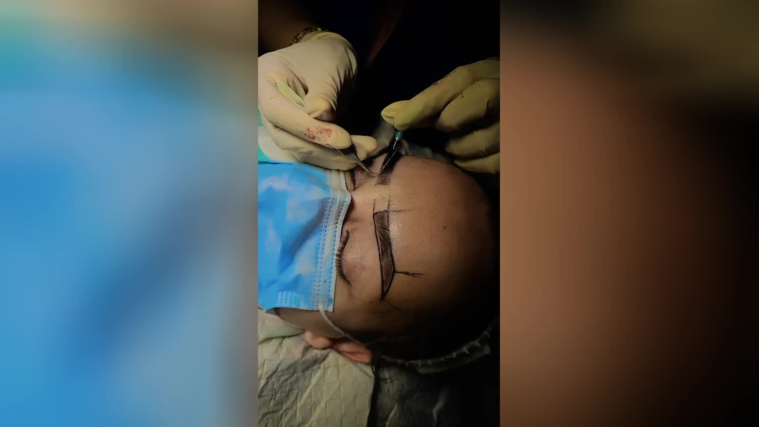 بهترین کلینیک کاشت ابرو در پارس آباد