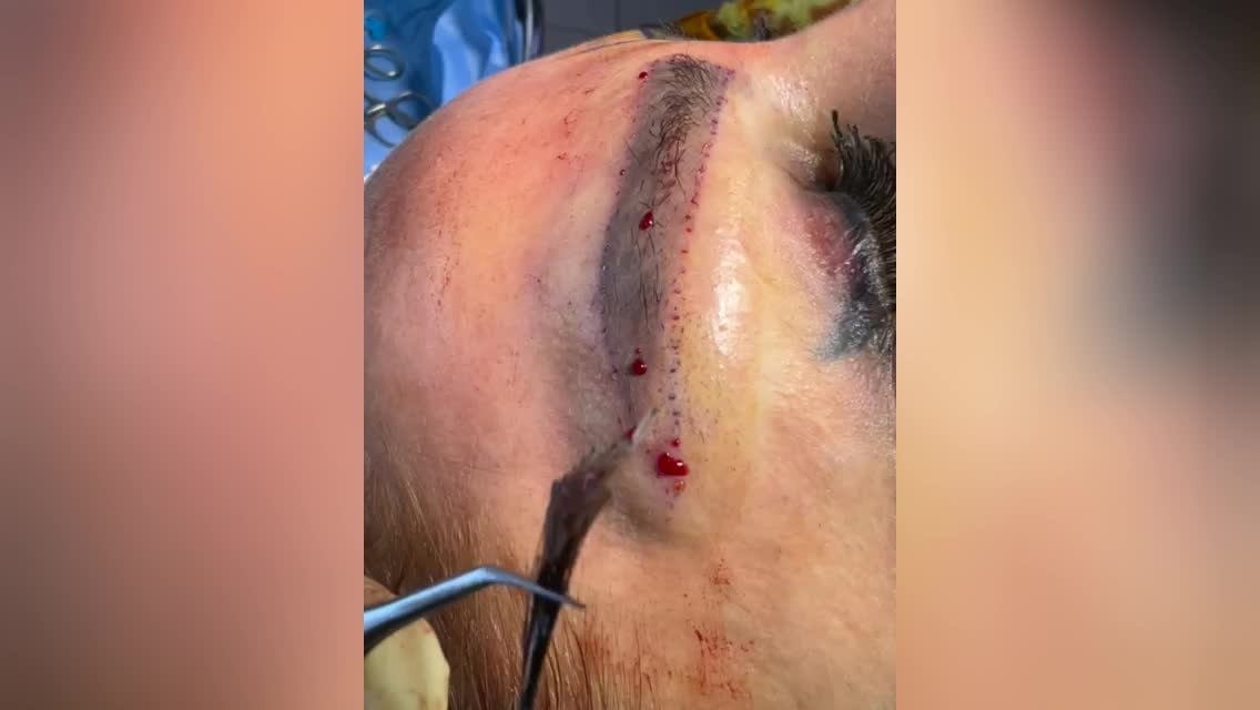 بهترین کاشت ابرو در پارس آباد