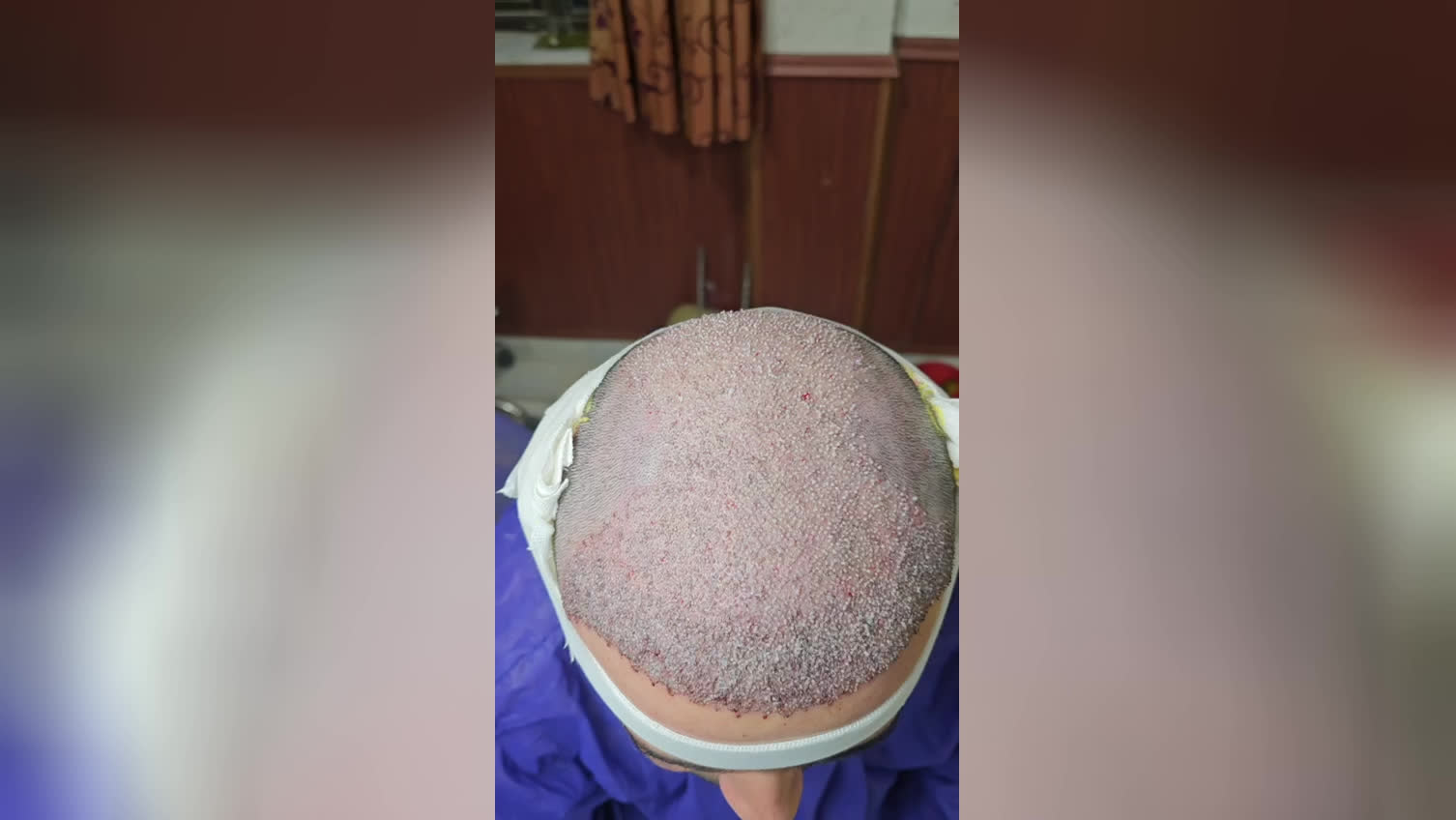 بهترین کلینیک کاشت مو در پارس